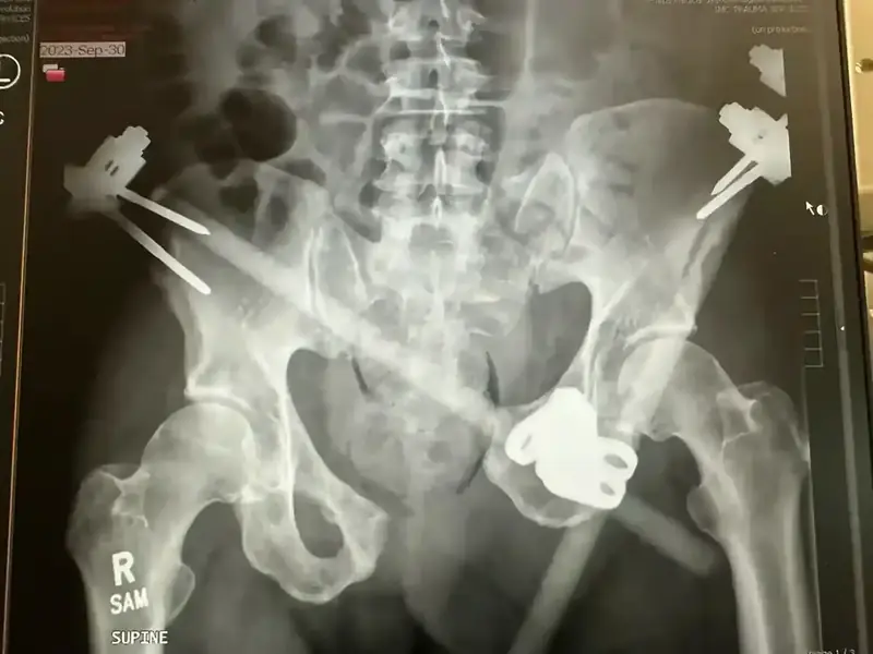 Before 1st Surgery X-Ray