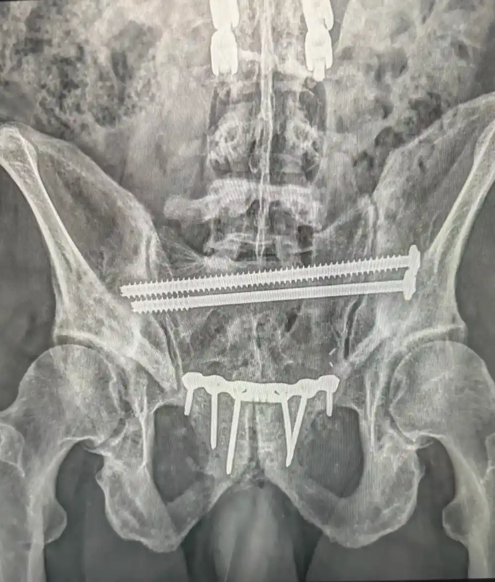 After 3rd Surgery X-Ray